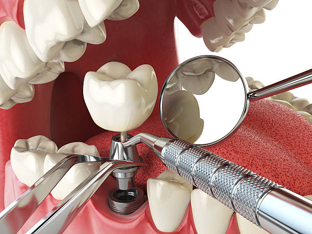 Best Emergency Broken Tooth Repair in Mila Doce, TX